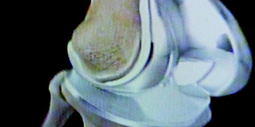 knee replacements
