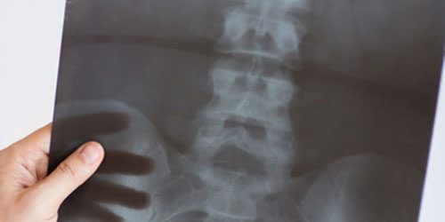 osteoartrosi-anca osteoartrosi