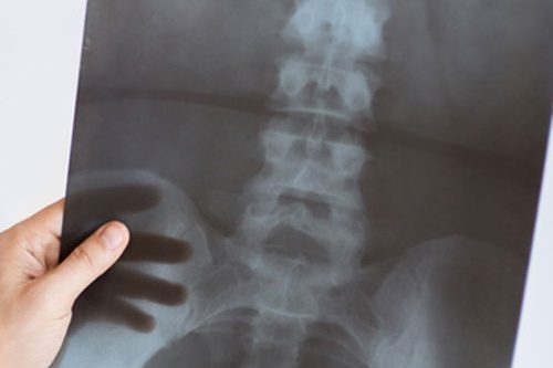 osteoartrosi
