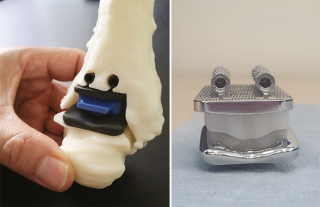 protesi stampata in 3D