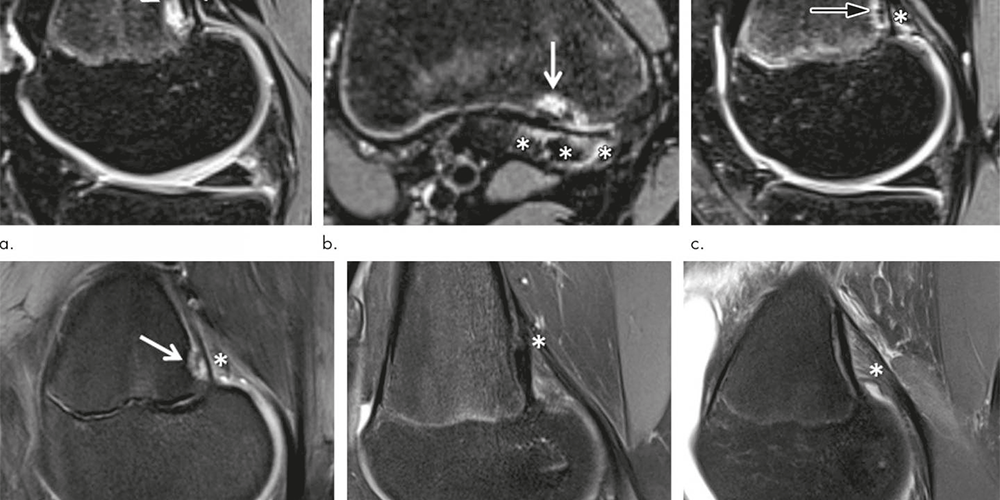 lesioni-femore-distale