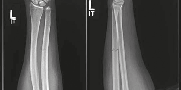 fratture-ulna