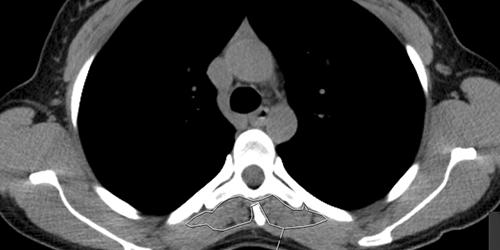 sarcopenia-covid-1