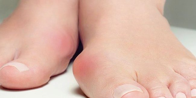 procedura-mininvasiva-alluce-valgo