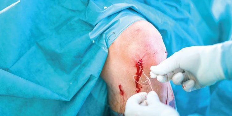 prevenzione-infezioni-sito-chirurgico