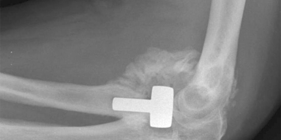 ossificazione-eterotopica-acido-tranexamico