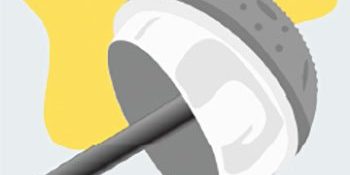 protesi-rivestimento-anca