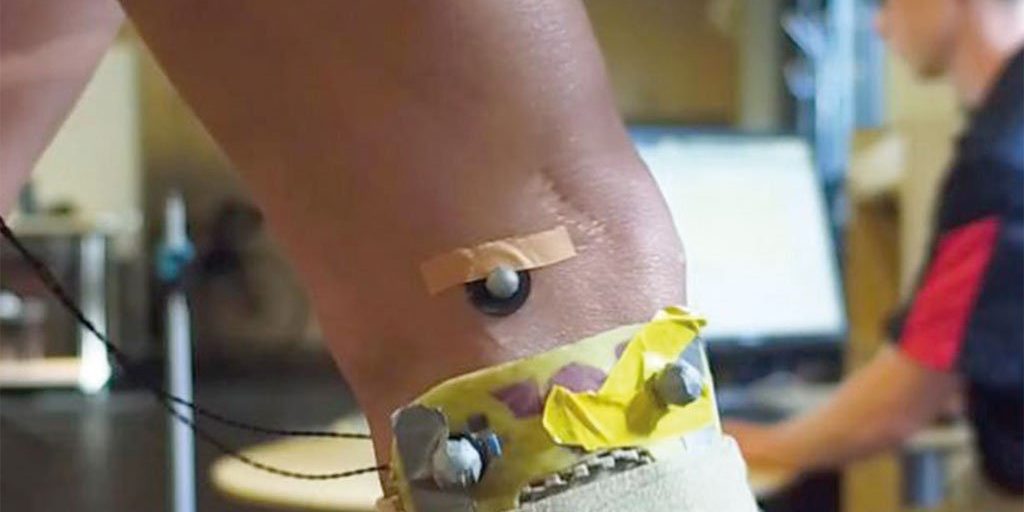 artrisu-ginocchio-terapia-personalizzata