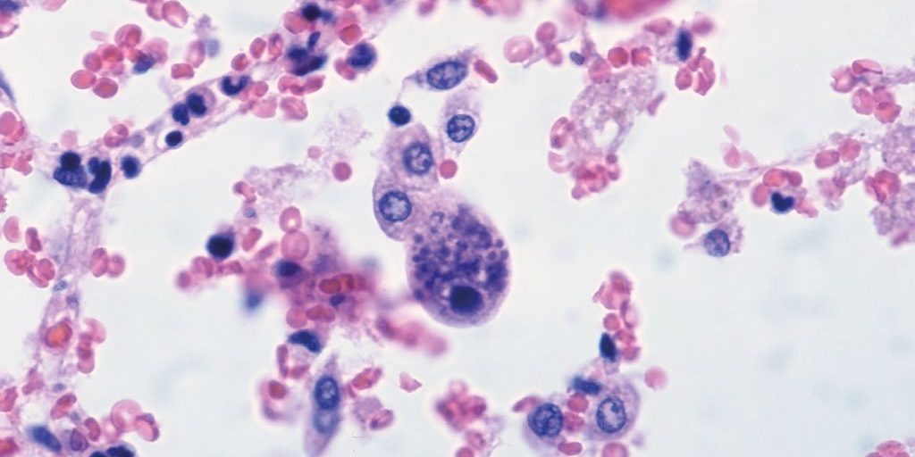 osteonecrosi